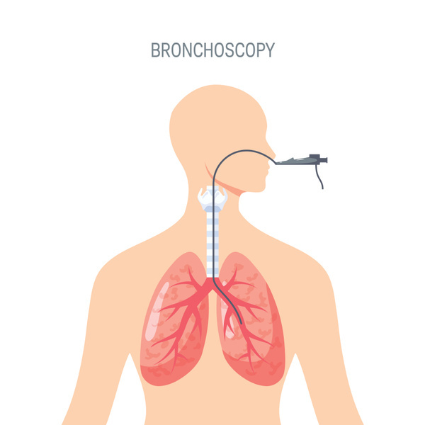 Bronkoskopi