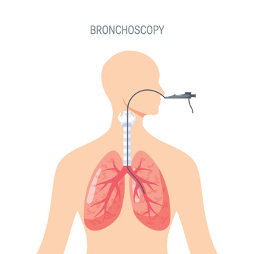 Bronkoskopi