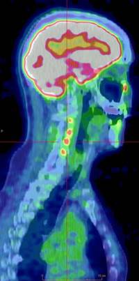 Nevrolymfomatose