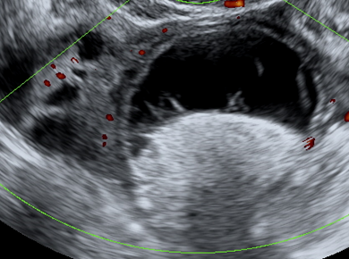 ovarian mass