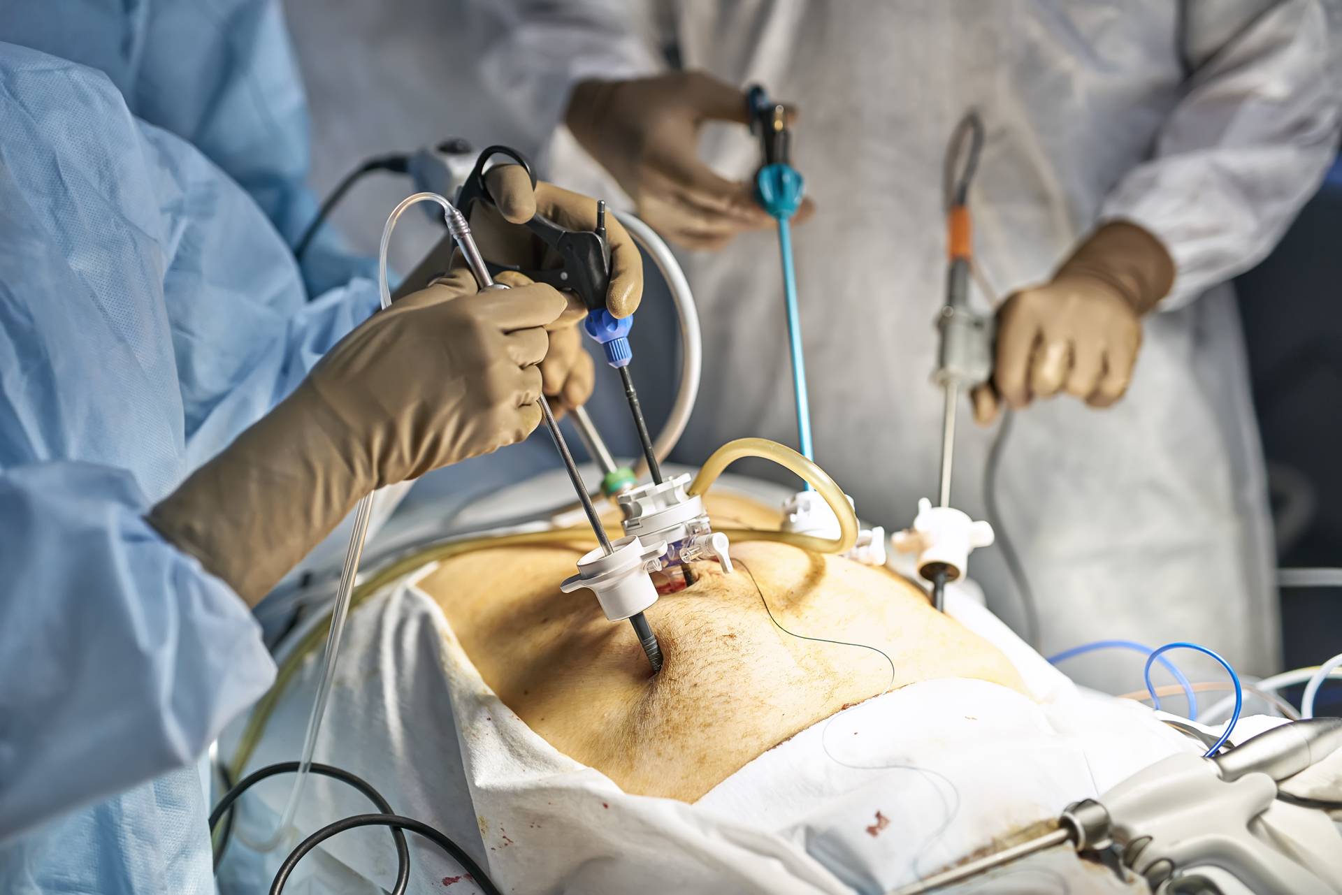 Underveis i en laparoskopi operasjon 